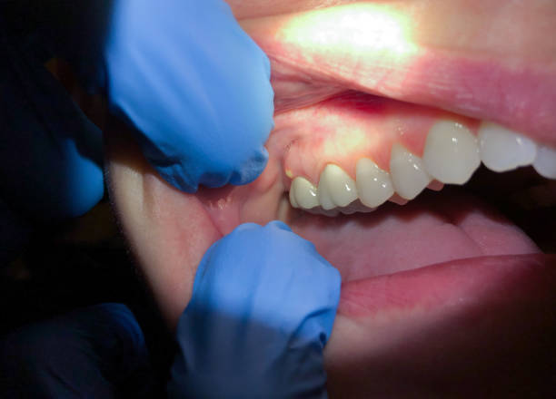 Best Emergency Tooth Extraction in Yale, MI